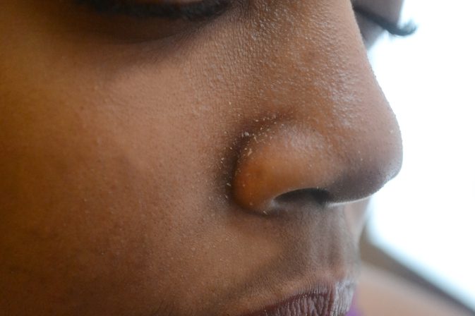 ముక్కు చుట్టూ నల్లమచ్చలు పోవాలంటే ఇలా చేయాలి..