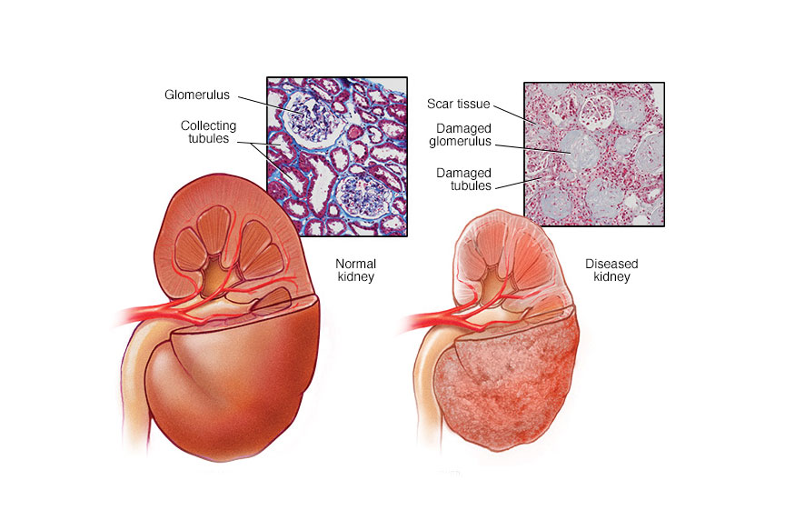 కిడ్నీ ఫెయిల్యూర్ అయితే.. సంకేతాలు ఇవి!