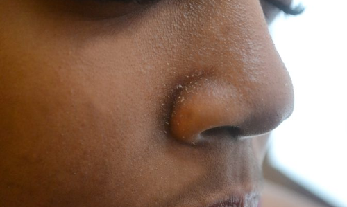 ముక్కు చుట్టూ నల్లమచ్చలు పోవాలంటే ఇలా చేయాలి..