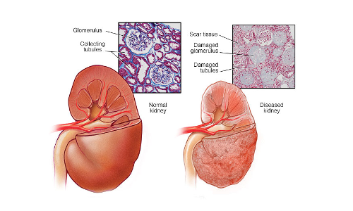 కిడ్నీ ఫెయిల్యూర్ అయితే.. సంకేతాలు ఇవి!