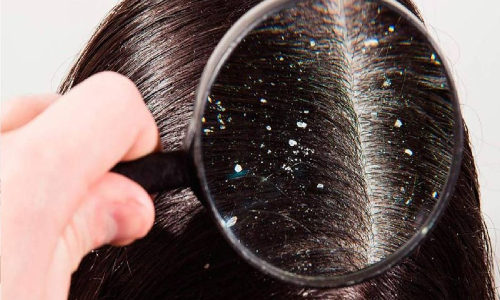 చలికాలంలో చుండ్రు సమస్య ఉందా.. అయితే ఇలా చేయండి..