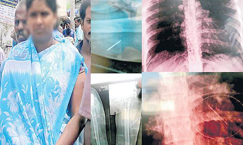 మహిళ గుండెలో సూది.. ఎలా వెళ్లిందో చూస్తే..