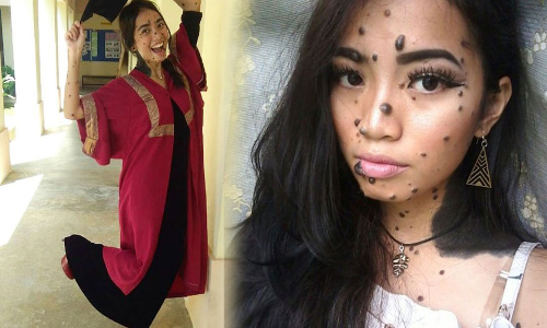 మచ్చలు మంచివే..