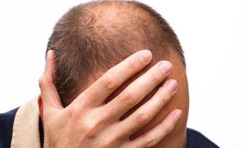 జుట్టు రాలడానికి ప్రధాన కారణం ఇదేనట..