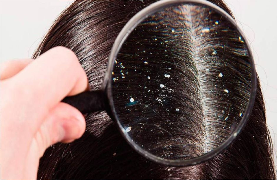 చలికాలంలో చుండ్రు సమస్య ఉందా.. అయితే ఇలా చేయండి..