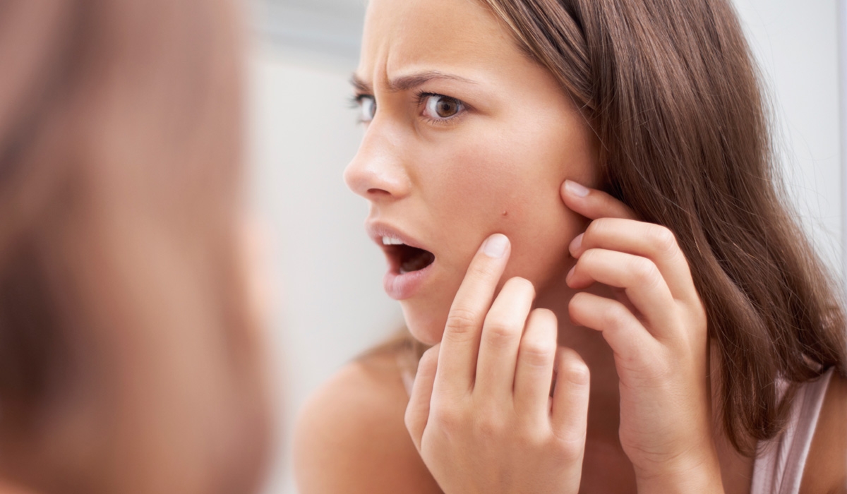 మొటిమలు.. పోగొట్టే చిట్కాలు