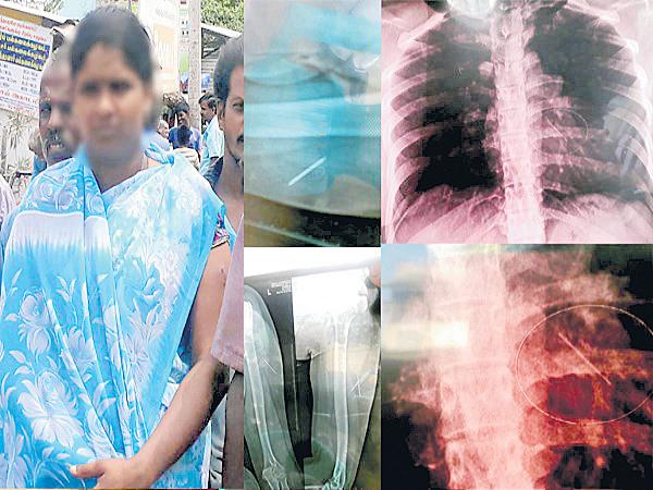 మహిళ గుండెలో సూది.. ఎలా వెళ్లిందో చూస్తే..