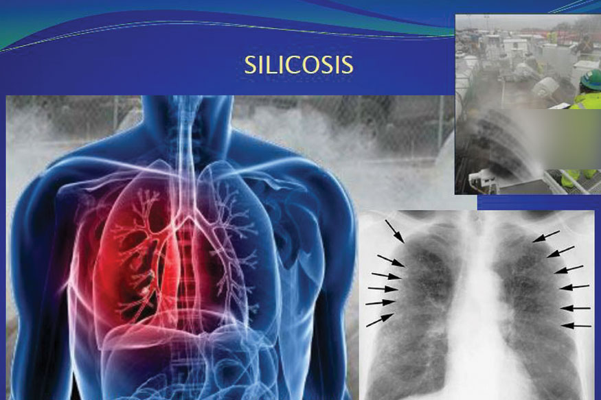 మృత్యువుకు రహదారి సిలికోసిస్