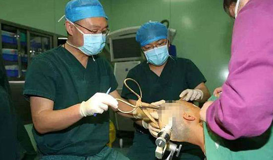 తలలోకి కత్తెర దూసుకెళ్లినా.. బస్సెక్కి ఆసుప్రతికి..