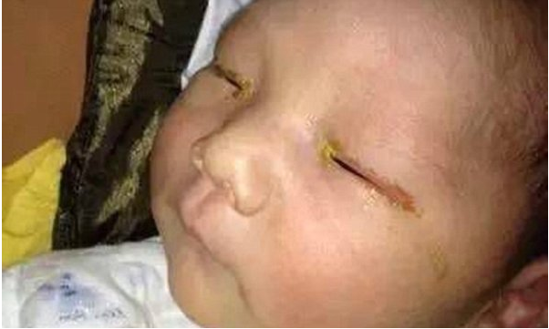 మొబైల్ ఫ్లాష్ తో చూపును కోల్పోయిన చిన్నారి