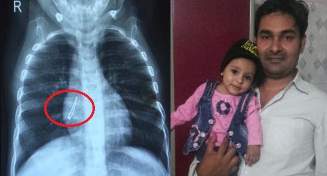 చిన్నారి ఊపిరితిత్తుల్లో ఎల్ ఈడీ బల్బ్ చిన్నారి ఊపిరితిత్తుల్లో ఎల్ ఈడీ బల్బ్